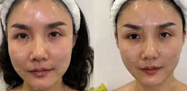 新颜智尚小程序一键预约，上海华美叶丽萍医生3D打印PEEK修复案例推荐