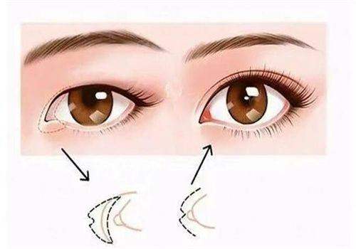 二、上海爱尚丽格杜园园医生眼修复，有哪些独门技术？