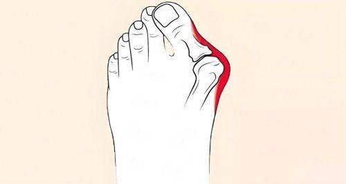 二、大连地区大脚骨矫正的价格与价值剖析