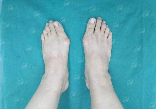 大连沙医生付德林大脚骨手术怎么样？看真实案例推荐与详细预约流程