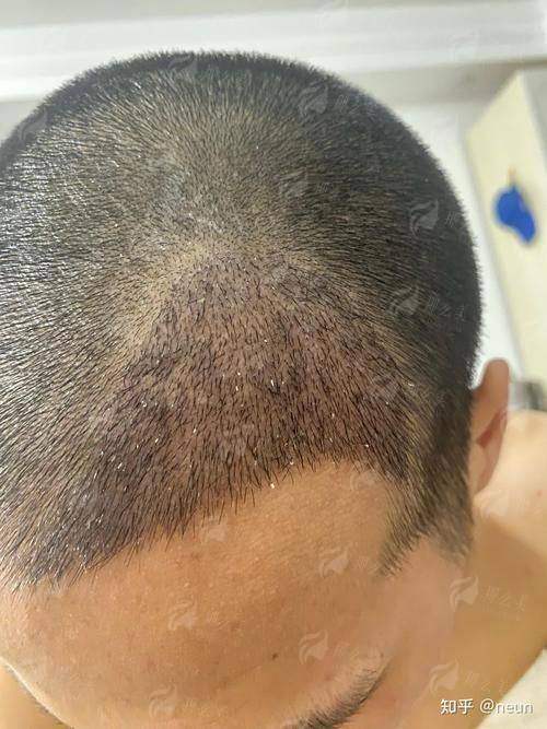 植发做得好吗？对比大连雅婷医疗美容植发效果与价格优惠攻略，小程序预约