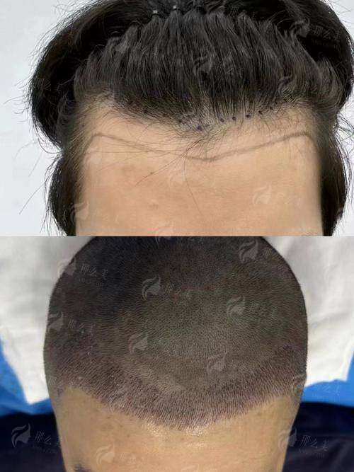 三、大连雅婷医疗美容的植发做得好吗？价格与价值的理性权衡