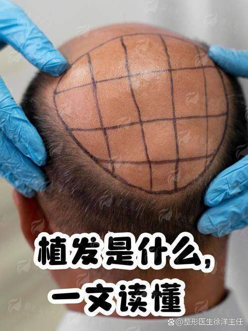 二、大连雅婷医疗美容的植发做得好吗？术前检测与方案设计是保护