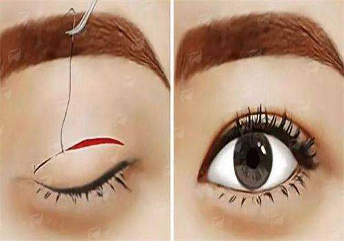 四、在温州名人整形医院做双眼皮手术需要注意什么？