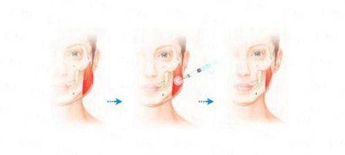 三、湖北襄阳伊莱美医疗美容做拉皮的价格与医生团队怎么样？