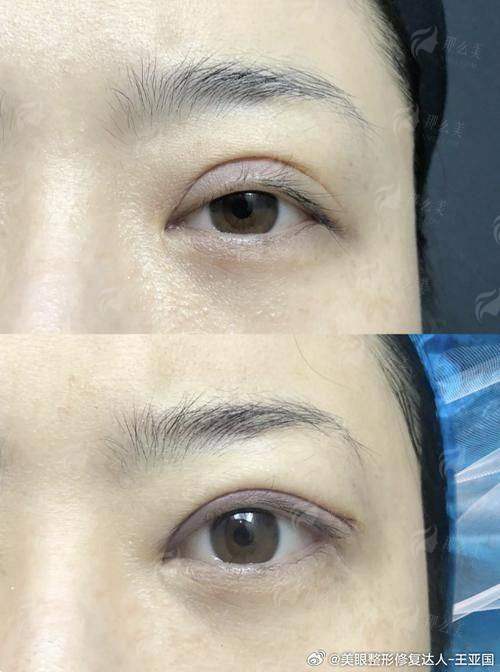 温州名人整形医院梁世号医生，双眼皮做得自然吗？新颜智尚小程序预约，看用户真实反馈