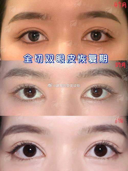 二、温州名人整形医院的双眼皮项目有什么特色？