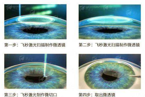 三、江苏苏州光明眼科医院的半飞秒手术价格与流程如何？