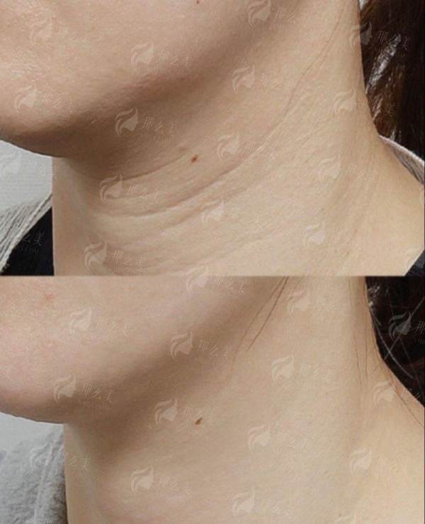 一、湖北襄阳伊莱美医疗美容的拉皮手术成效如何？