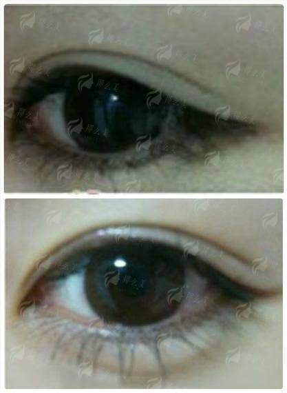 二、新疆威兹曼整形外科医院的双眼皮技术好吗？