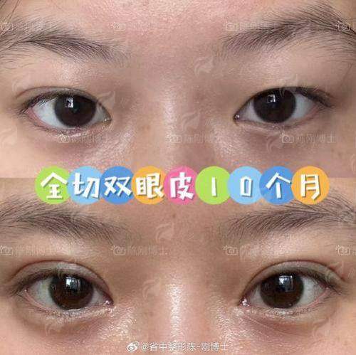 三、新疆威兹曼整形外科医院的双眼皮有什么优势？