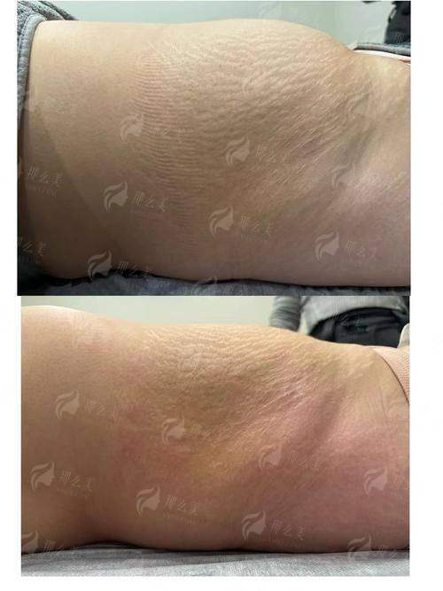 一、新疆威兹曼整形外科医院的吸脂手术原理是什么？