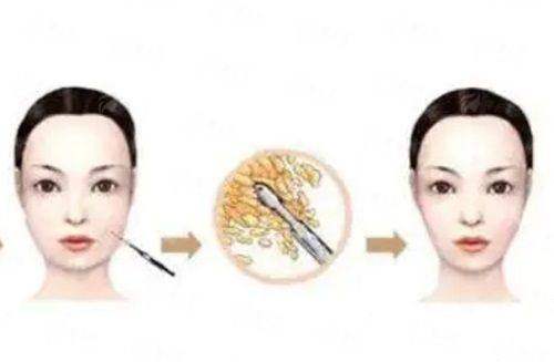 广州广大整形内窥镜拉皮，微创提升体验与预约方式详解，新颜智尚小程序