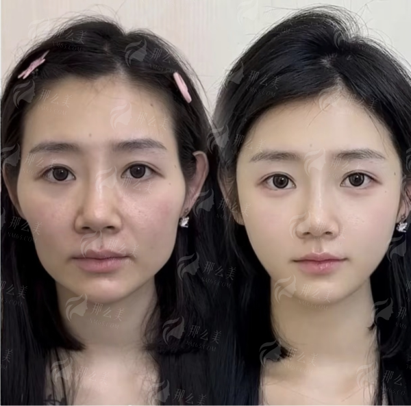 二、广州广大整形医院的内窥镜拉皮手术医生团队好吗？