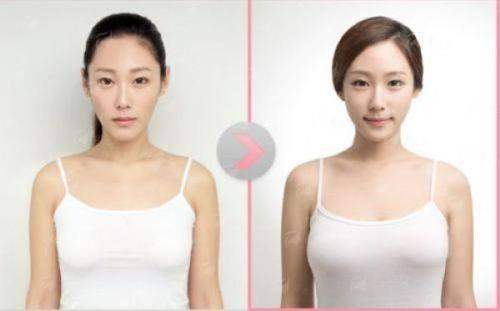 广州隆胸找陈保荣医生，焕新颜医疗美容口碑之选，预约方式及用户反馈一览