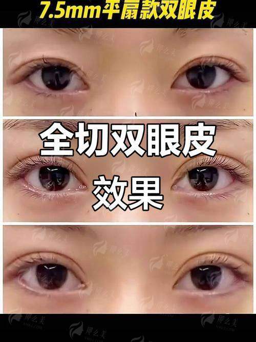 四、如何预约广州焕新颜医疗美容进行双眼皮面诊?完整攻略在这里