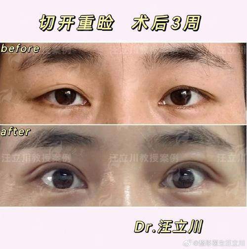 二、抛开“曹云飞医生双眼皮”的执念,看广州焕新颜医疗美容如何定制你的双眼皮方案?