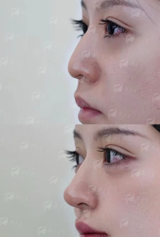 三、吉林长春悦美汇整形的隆鼻修复术后护理有什么特色？