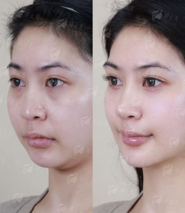 <strong>二、王晓健医生人中手术的适合人群与面诊流程:北京蕾士悦容整形如何把关</strong>