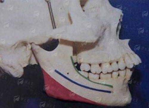 五、苏州维多利亚美容医院假体隆胸价格对比分析