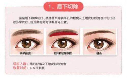 四、苏州维多利亚美容医院陈玉连双眼皮真实实例分享