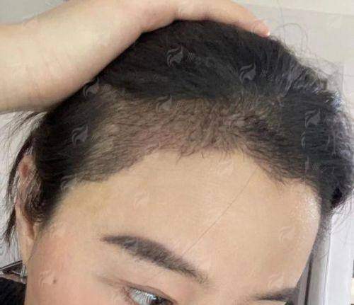 二、包头吴姝华美植发的发际线种植流程具体怎么走?