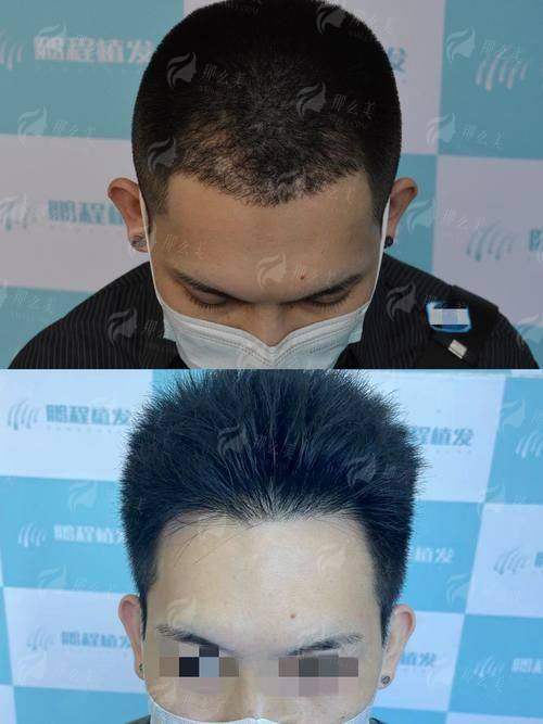 一、包头吴姝华美植发的发际线种植技术怎么样?