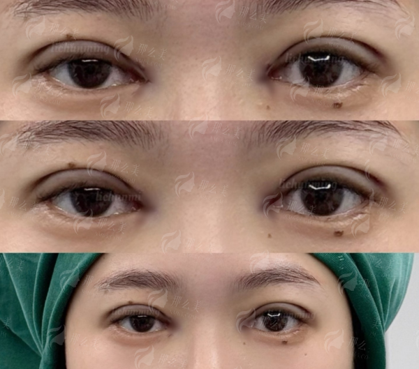 四、苏州维多利亚美容医院双眼皮手术真实实例分享