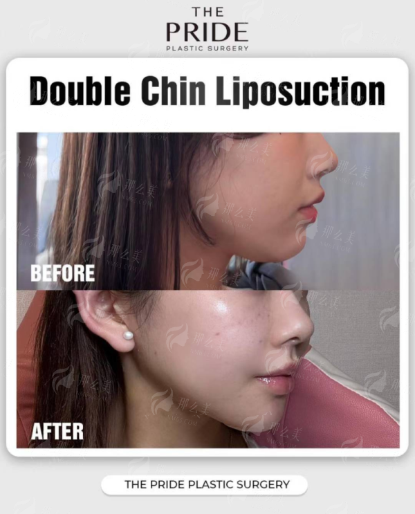 <strong style="color:red;">六、如何获取个性化隆胸方案</strong>