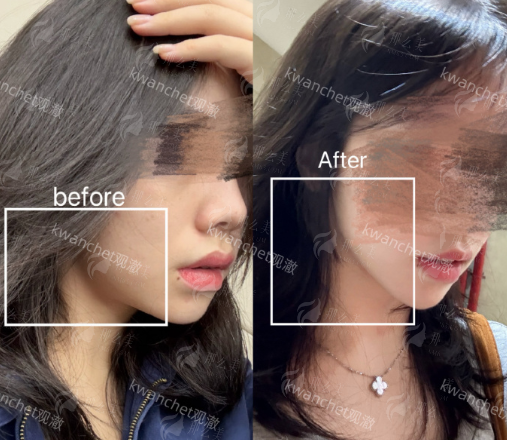 三、苏州维多利亚美容医院阎红肋骨隆鼻真实实例分享