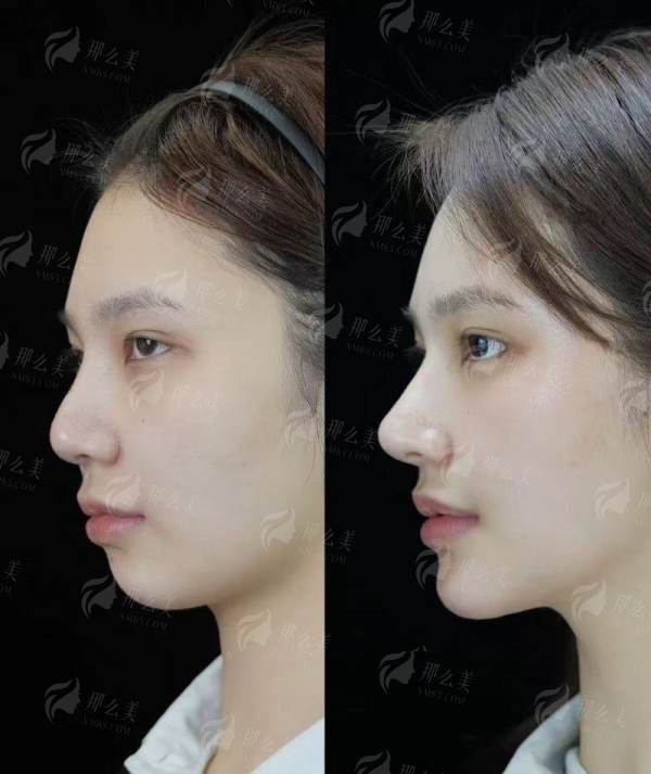 <strong>二、苏州维多利亚假体隆胸术前定制化服务流程</strong>