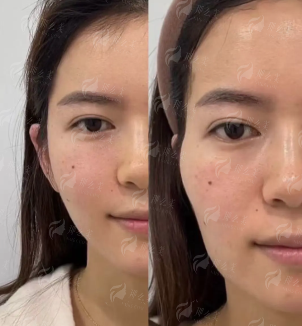 四、苏州维多利亚美容医院肋骨隆鼻术后护理指南