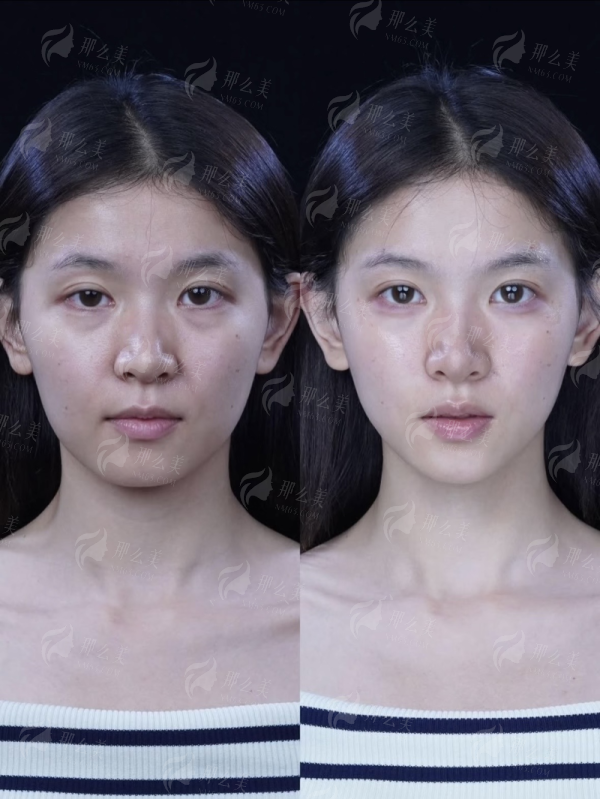 苏州维多利亚刘大猛和阎红双眼皮谁最自然全解析，到院地址及新颜智尚小程序预约方式公开