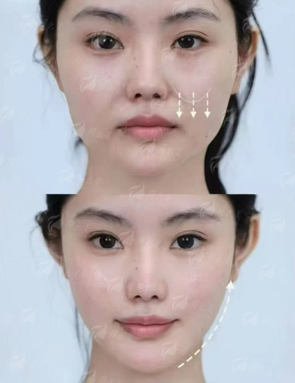 三、苏州维多利亚美容医院假体隆胸技术特色