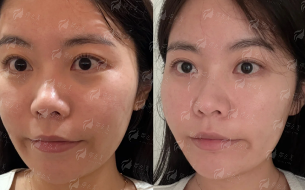 苏州维多利亚美容医院许云鹏肋骨隆鼻案例效果全公开！想了解的速来，附坐诊地址及预约挂号方式