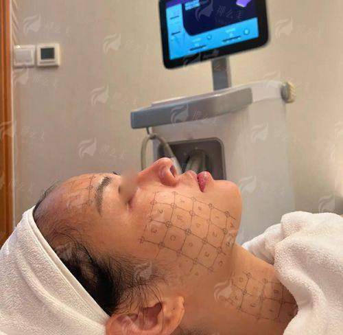 一、海口龙华崔曦文整形的新一代热玛吉，正版保护到底有多硬核？