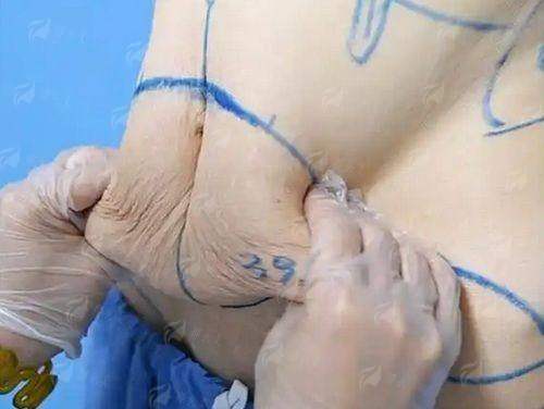 <strong>二、福建福州名韩医疗美容的隆鼻技术好吗?</strong>