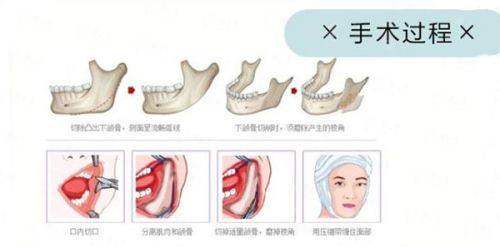 <strong>三、福建福州名韩医疗美容的隆鼻有什么优势?</strong>