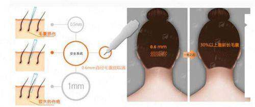 一、邯郸佑熙莲禾植发的发际线种植技术靠谱吗？