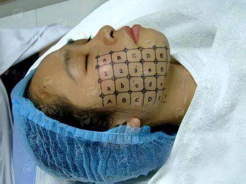 三、海口龙华崔曦文整形的新一代热玛吉，成效、价格与适合人群全解析