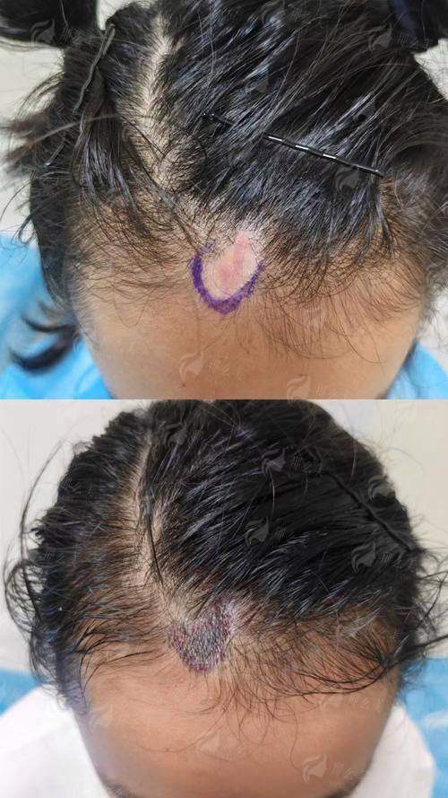 二、邯郸佑熙莲禾植发的发际线种植过程与成效如何？