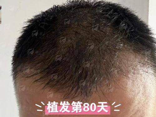 三、邯郸佑熙莲禾植发的发际线种植价格与预约方式详解