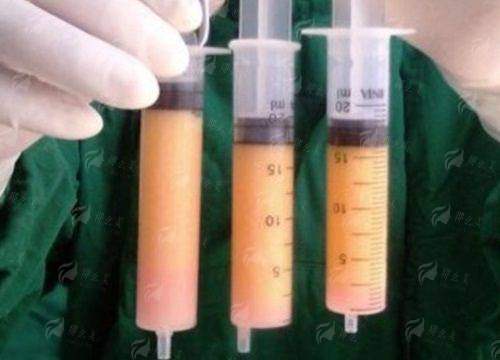 二、连云港吸脂好医院有哪些?国有医院整形外科解析