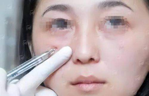 三、沈阳腾采医疗美容的孟强院长拉皮，价格、口碑与对比