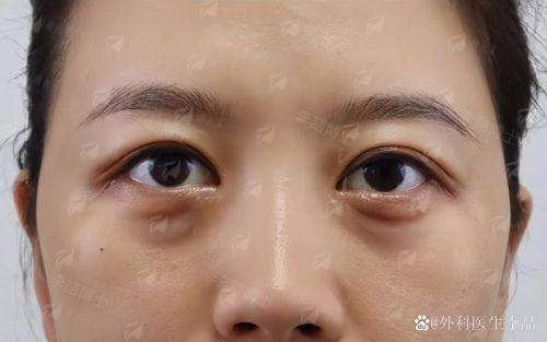 二、厦门思明美仑美奂医疗美容的祛眼袋价格贵吗?