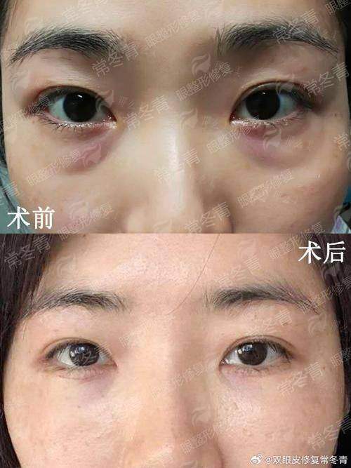 三、厦门思明美仑美奂医疗美容的祛眼袋术后修复与成效如何?