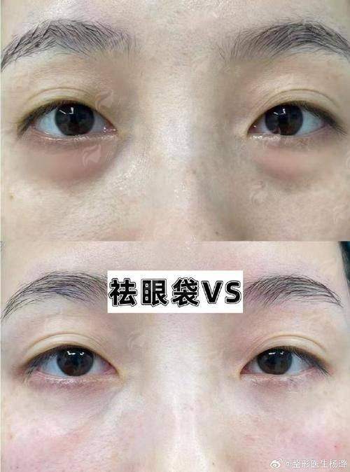 一、厦门思明美仑美奂医疗美容的祛眼袋技术怎么样?