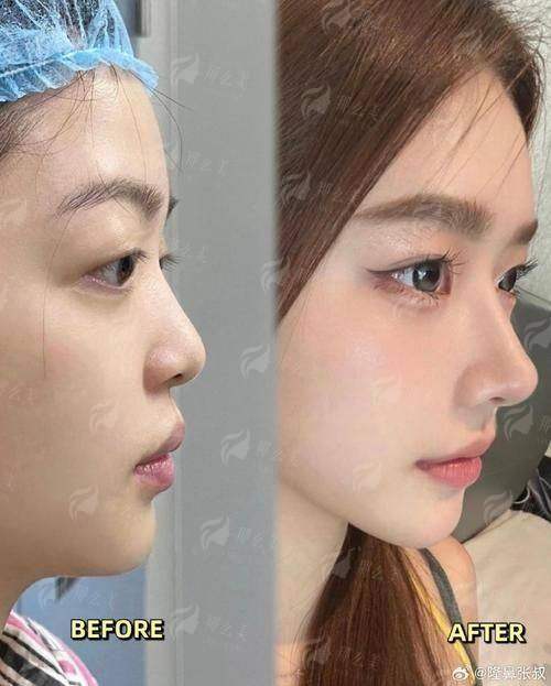 三、在贵阳市甲秀医疗门诊部做驼峰鼻矫正,术后怎么护理?