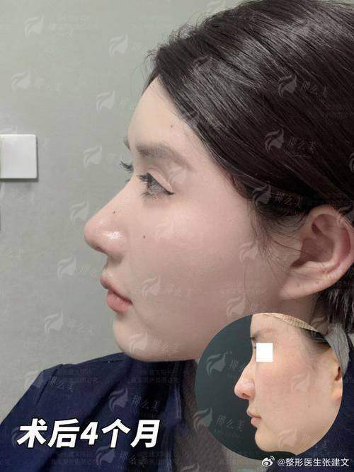 二、贵阳市甲秀医疗门诊部做驼峰鼻矫正价格贵不贵?