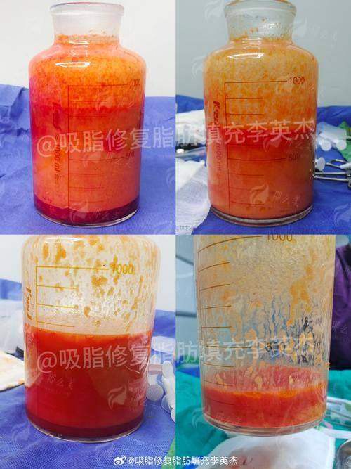 三、连云港吸脂好医院有哪些?如何对比与选择?